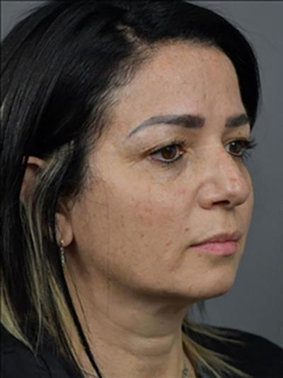 Amélie, 34 ans - Before